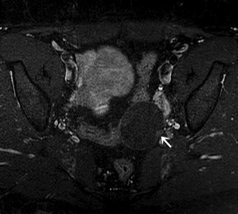 Current Update On Borderline Ovarian Neoplasms Ajr