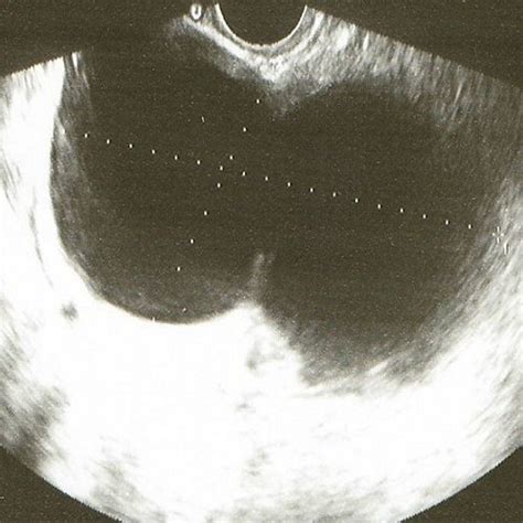 Borderline paratubal cyst: The epithelium showed nuclear... | Download ...