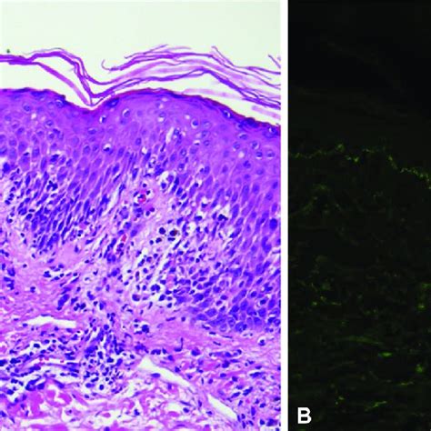 Histopathologic Findings Of Lpp A A Punch Biopsy Of Lesional Skin