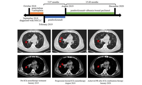 Topic Lung Cancer Drug Resistance