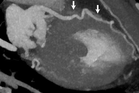 Role Of Coronary Ct Angiography In Spontaneous Coronary Artery