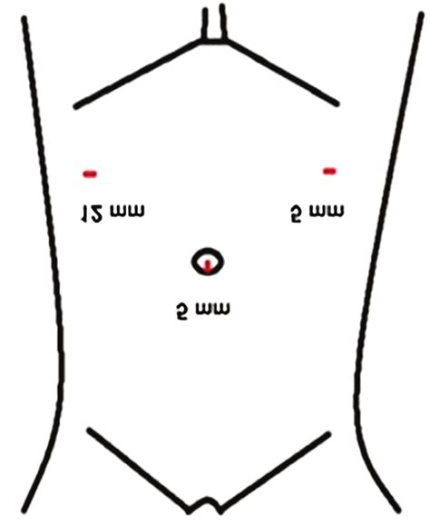 Surgical Port Position The Port Location For Emergency Laparoscopic