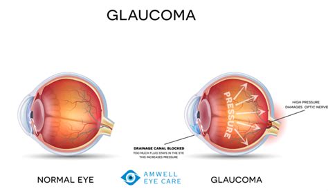 Glaucoma Facts You Should Know Amwell Eye Care