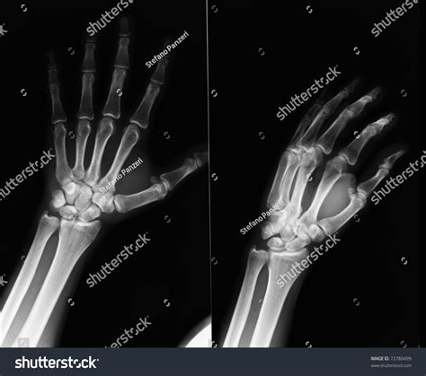 Xray Hands Stock Photo 72780499 - Shutterstock