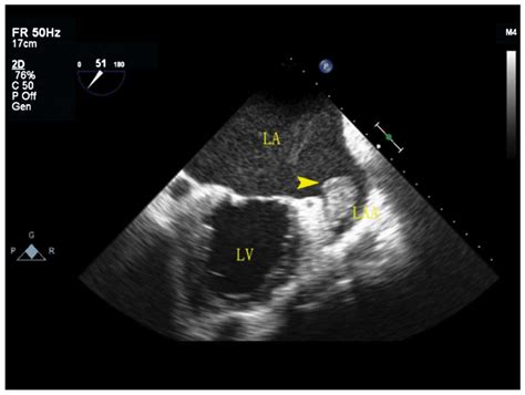 Analysis Of Real Time Three Dimensional Transesophageal