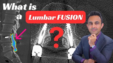 What Is A Lumbar Fusion Surgery Youtube