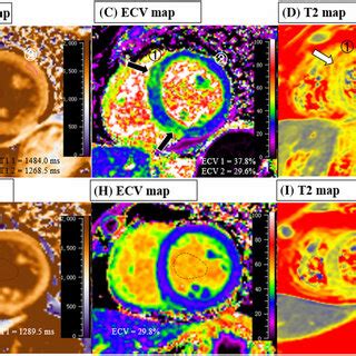 Regadenoson Electrocardiographic And Spect Findings In Patient Panel