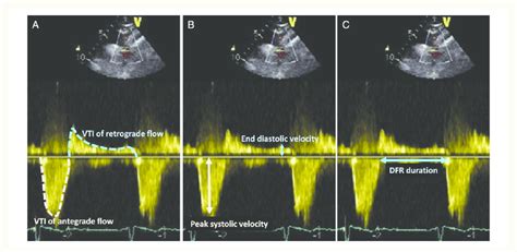 A The Velocity Time Integral Vti Of Descending Aortic Diastolic