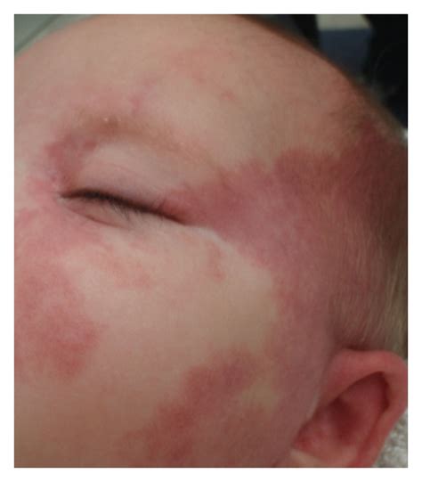 Capillary Malformation Port Wine Stain Of The Left Face In Infant Download Scientific Diagram