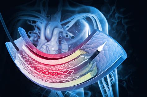 Procedimiento De Angioplastia Con Stent En Vena Stock De Ilustraci N