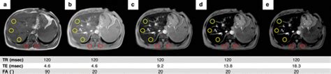 Liver Iron Quantification With Mr Imaging A Primer For Radiologists