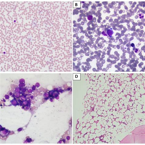 A D Figure Depicting The Bone Marrow Biopsy Specimen Of A Patient