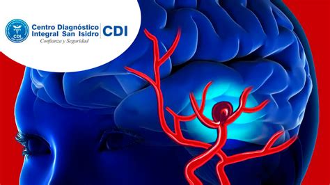 Aneurisma Cerebral Cdi San Isidro Resonancia Tomograf A