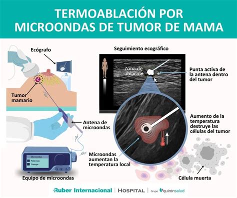 Termoablación Por Microondas Para El Tratamiento De Tumores De Mama