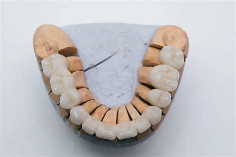 Qu Son Las Pr Tesis Totales Clinica Dental Sonrisa Segura