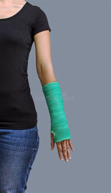 Broken Arm With Green Cast On White Background Stock Photo - Image of ...