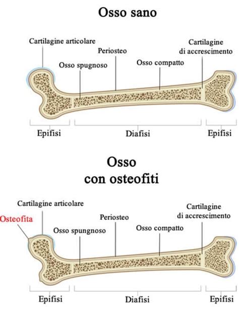 Osteofitosi