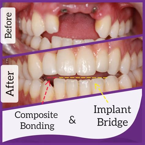 Composite Dental