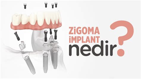 Zigoma Implant Nedir Youtube