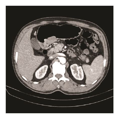 Initial Abdominal Computed Tomography Scan A~c And Follow Up Scan Download Scientific Diagram