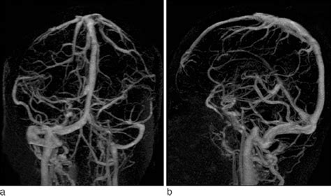 Contrast Enhanced Cerebral MR Venography Comparison Between Arterial