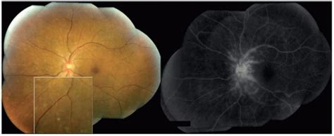 Posterior Uveitis And Collagen Vascular Diseases Ento Key