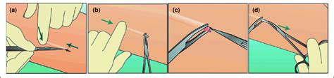 'Pop-out' removal technique with Implanon ®. © NV Organon, Oss, The ...