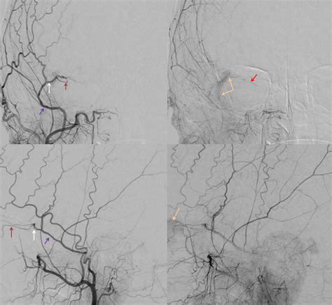 Middle Meningeal Artery