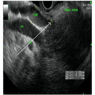 Endoscopic ultrasound images arrows showing (clockwise) (a) CBD ...