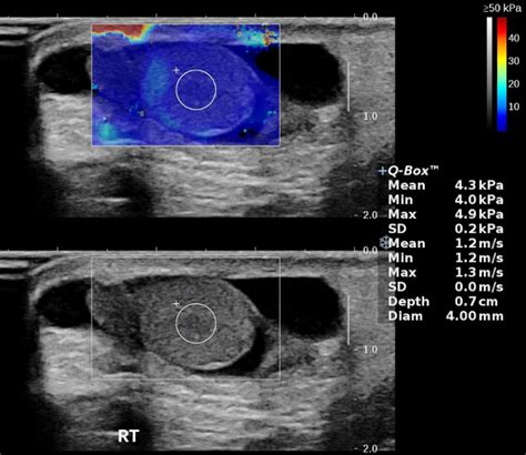 Normal Changes And Ranges Of Pediatric Testicular Volume And Shear Wave