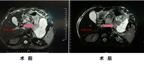 晚期胰腺癌海扶刀治疗病例陈谦主治医师爱问健康