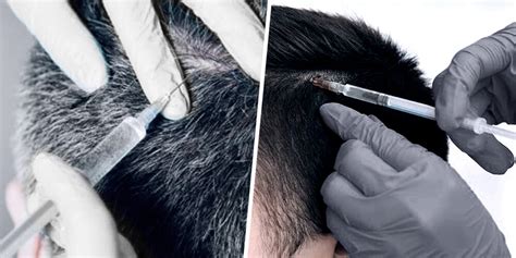 Mesotherapy For Hair Loss Premier Clinic