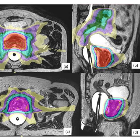 Examples Of Magnetic Resonance Guided Stereotactic Body Radiotherapy