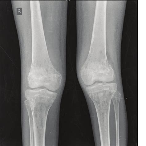 X Ray Of The Knee Joint Showing Multiple Lytic In The Bones Around The Download Scientific