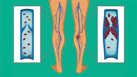 Phlebitis Iv Signs And Symptoms Phlebitis Symptoms Causes And