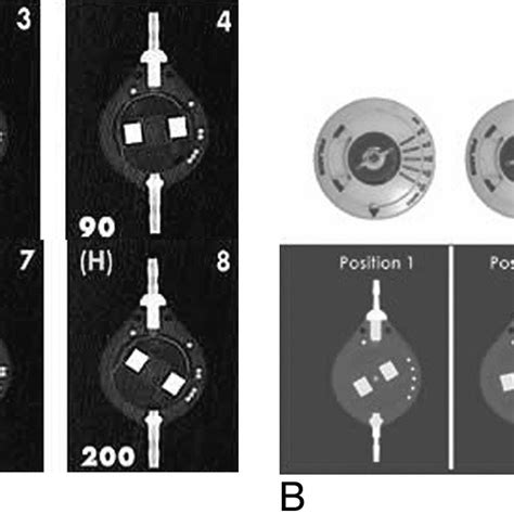 Pdf Programmable Csf Shunt Valves Radiographic Identification And