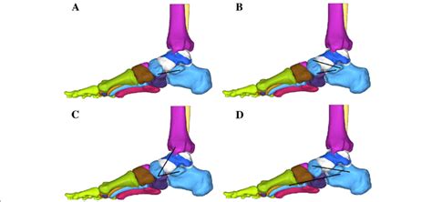 models  reconstructed tendon grafts inferior spring ligament