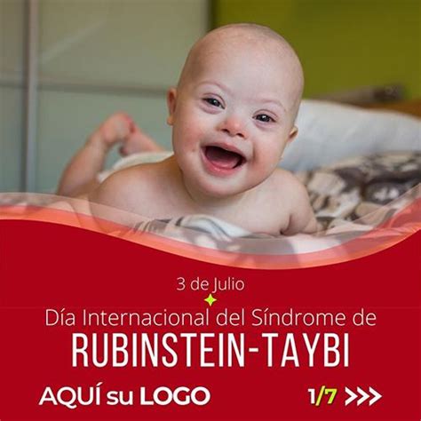 Julio D A Internacional Del S Ndrome De Rubinstein Taybi