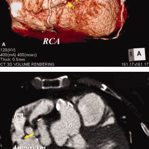 A Three Dimensional Volume Rendering Image Of Mdct Shows Dilatation