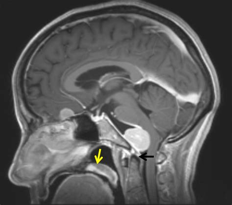 Case Archives — Clival And Foramen Magnum Meningioma Embolization And