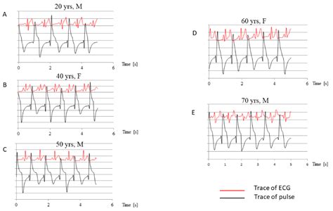 Jcm Free Full Text Pleural Pressure Pulse In Patients With Pleural