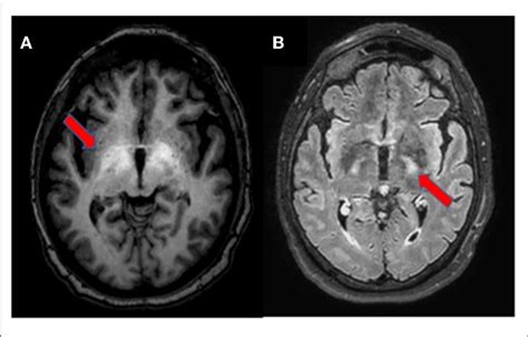 Brain Mri Axial Section T1 Weighted Imaging Showing Bilateral Download Scientific Diagram