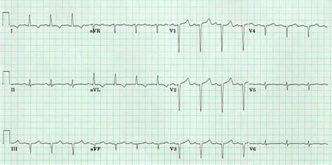 Anterior Infarct Ecg Changes