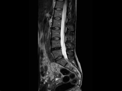 Lumbar Plexus Mri