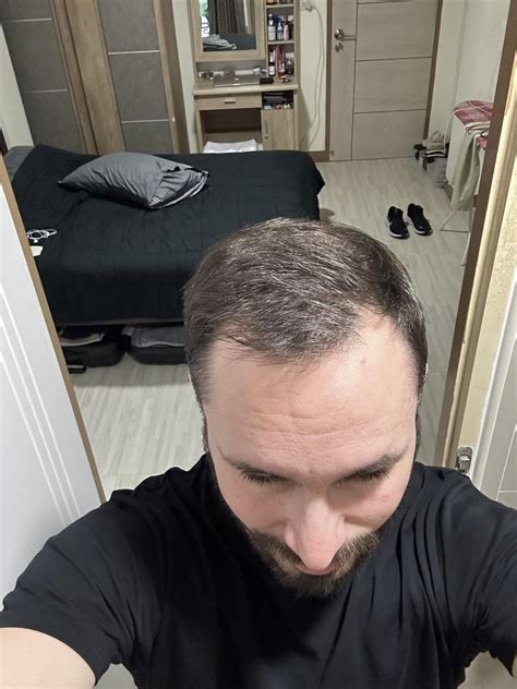 Finasteride And Minoxidil 3 Months R Tressless