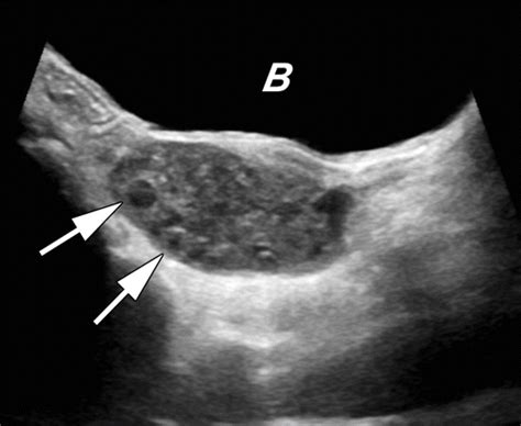 Pediatric Ovarian Torsion Spectrum Of Imaging Findings Radiographics