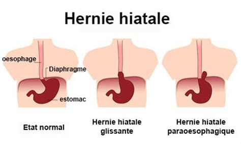 Opération hernie hiatale effets secondaires dysphagie fatigue