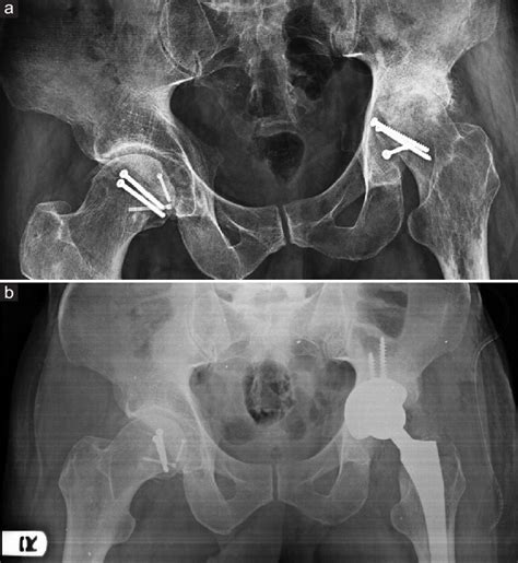 Radiographs Of The Patient In The Th Month Of Follow Up A