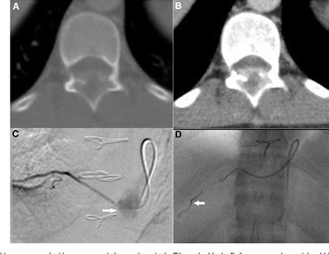 Figure 12 From The Radiologic Diagnosis And Treatment Of Typical And