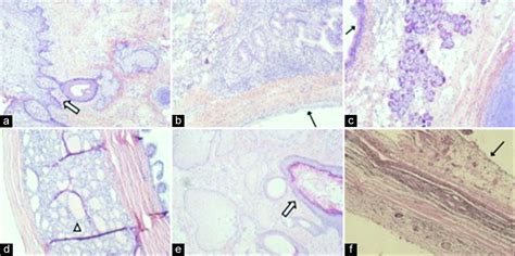 Concurrent Bilateral Presentation Of Immature And Mature Ovarian